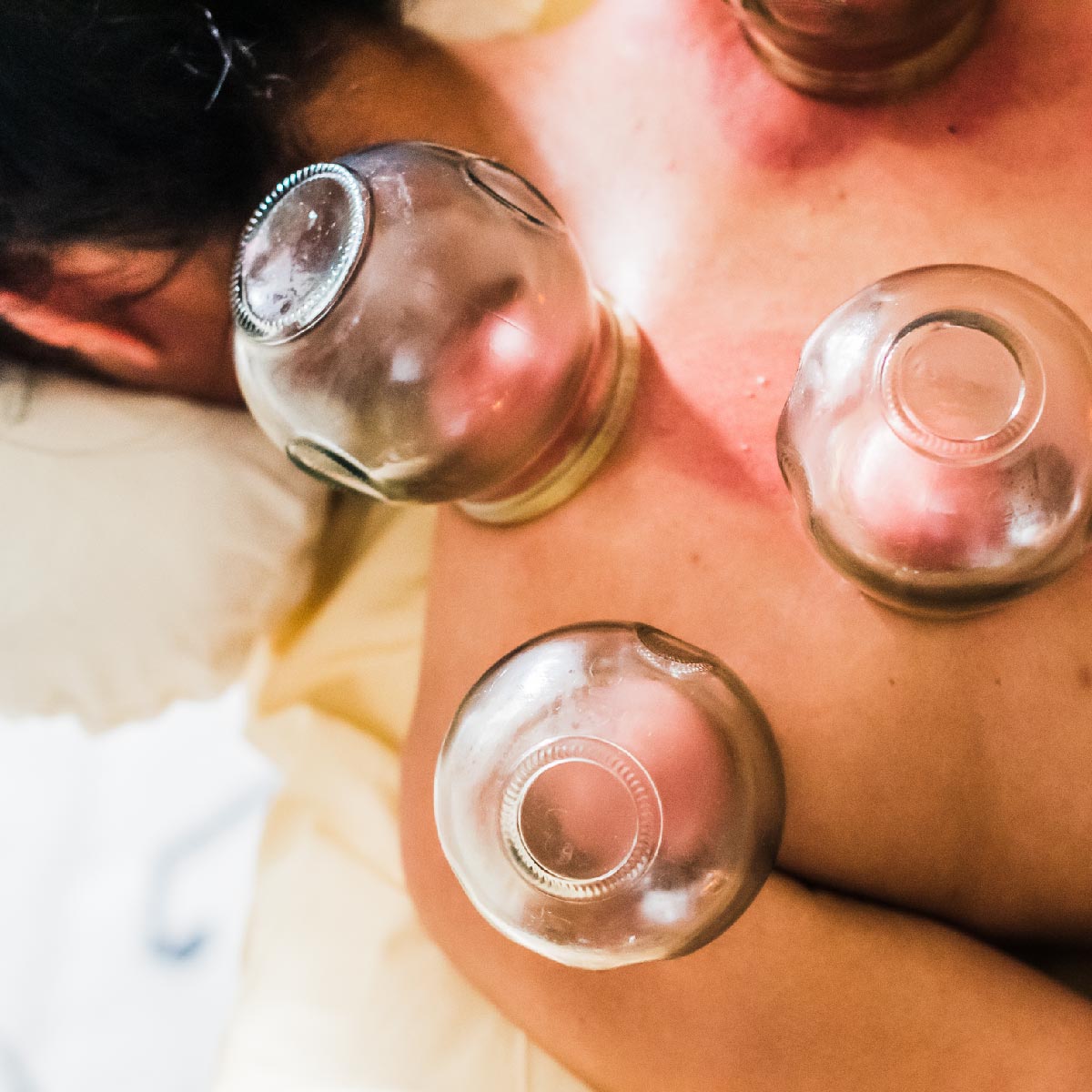 Cupping