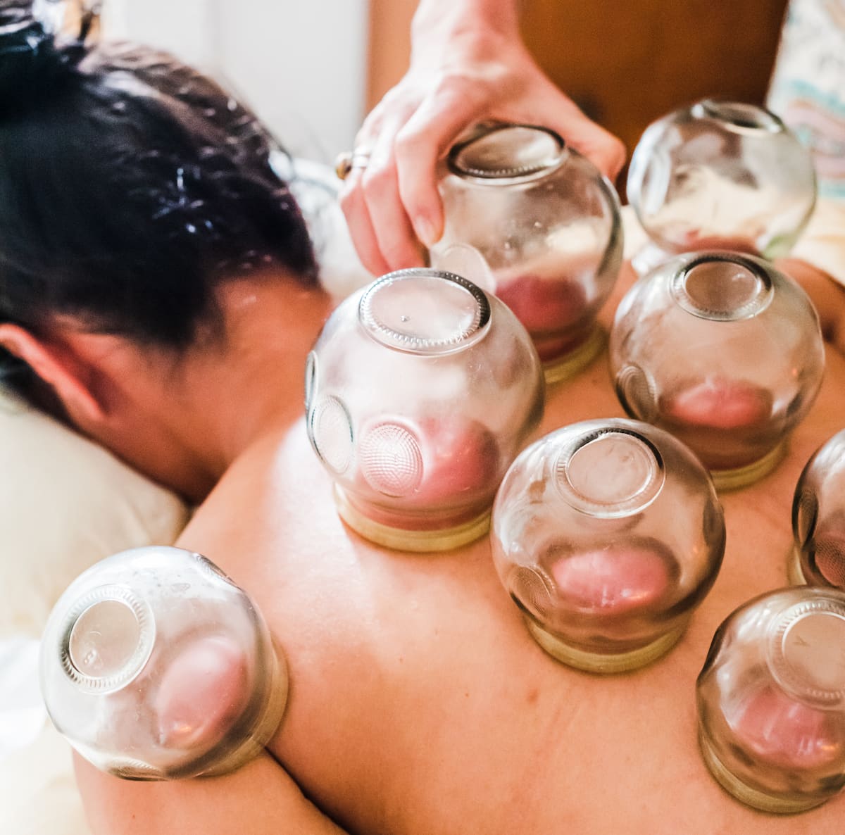 Cupping